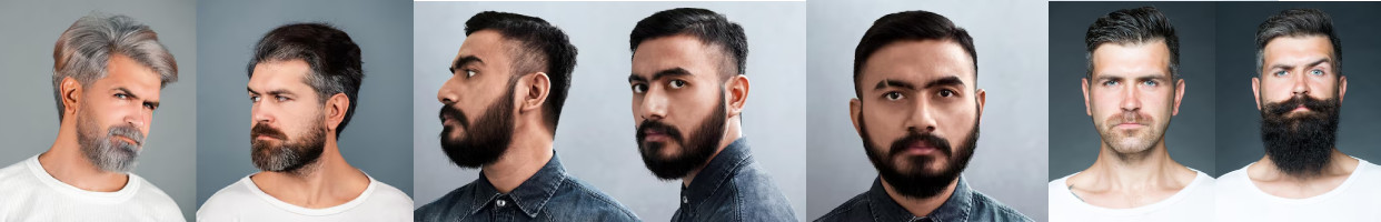 کاشت مو ، نمونه کاشت مو ، قبل و بعد